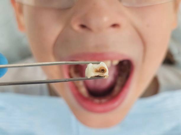 Best Emergency Dental Care for Broken or Chipped Teeth in Columbia Heights, MN