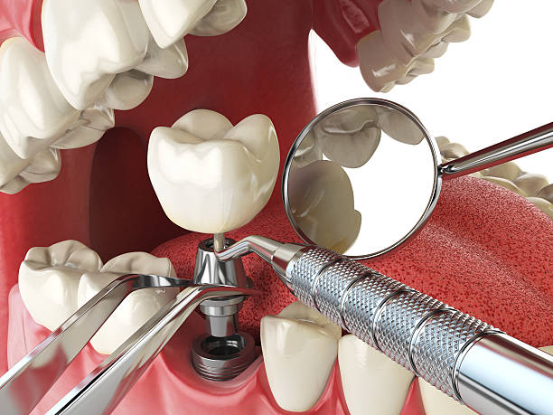 Best Emergency Dental Care for Broken or Chipped Teeth in Columbia Heights, MN